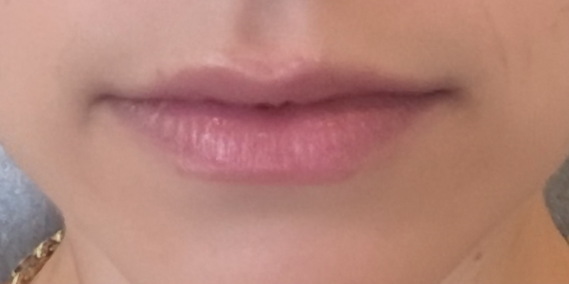 lip-filler-before