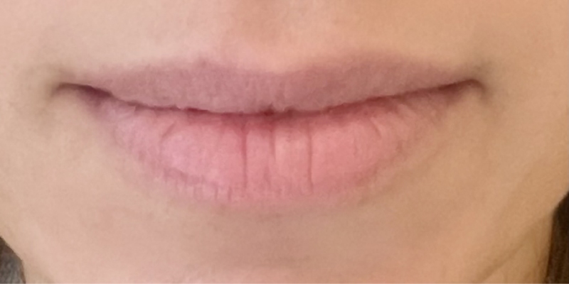 lip-filler3-before