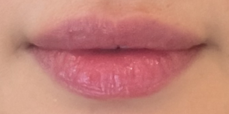 lip-filler4-after