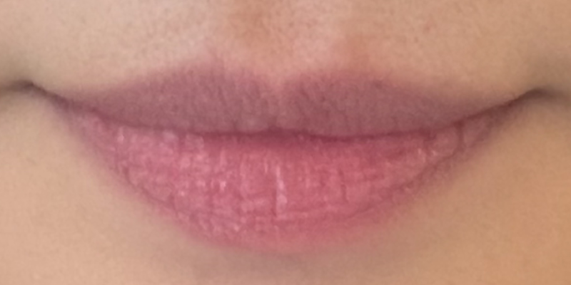 lip-filler4-before