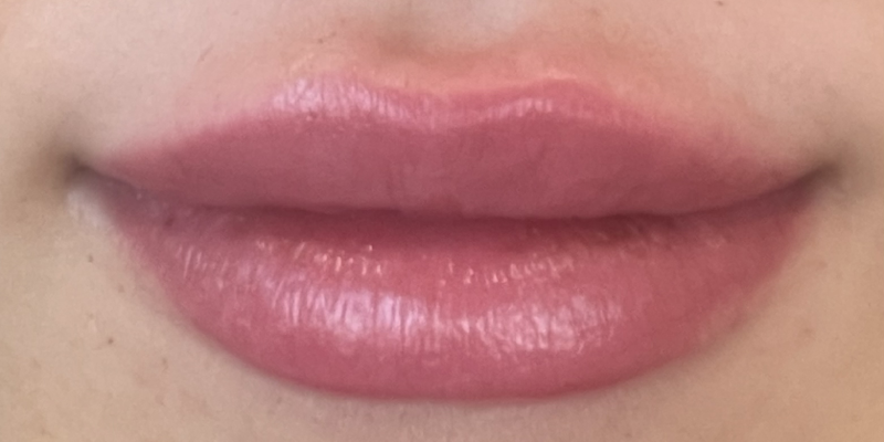 lip-filler5-after