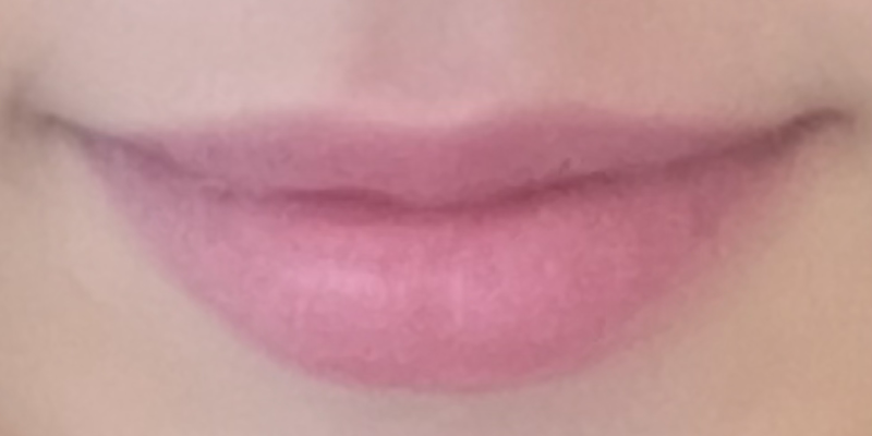 lip-filler5-before